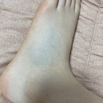 [드루와] 나 발등 조카붓고 아픈데 <b>인대</b>늘어난거야?ㅠ