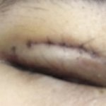 [댓글부탁해] 혐주의) 쌍수 <b>실밥</b> 풀린거임?ㅠㅠ