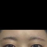 쌍수 <b>이틀</b>찬데 눈좀 봐줭(사진ㅇㅇ)