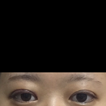 쌍수햇는데 <b>속</b><b>쌍</b>될거같나??(사진있어)