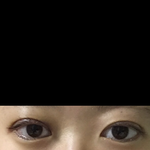 쌍수했는데 <b>속</b><b>쌍</b>될거같나???(사진ㅇ