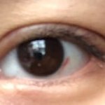쌍수 절개 <b>재수술</b>후기!!@@ 라인좀 봐주세요!