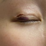 쌍수 후 벌어진 부위 저절로 아무나요!?