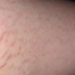 [댓글부탁해] 붉은튼<b>살</b> 어떻게없애ㅠㅠ