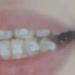 [드루와] <b>이빨</b> 교정한지 4일짼데 교정한애들 들어오ㅏ봐ㅜㅜ