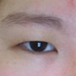 나 안검<b>하수</b> 인가