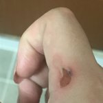 [제발도와줘] 혐)뜨거운<b>시럽</b> 손가락에 떨궜는데