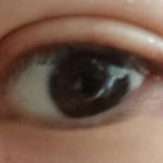 (<b>눈사진</b> 있음) 오늘 쌍수 실밥 풀고왔당ㅎㅎ