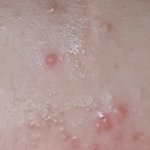 (혐주의) 나 <b>미간</b>이랑 이마에 ㅠㅜㅜ