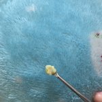 [드루와] 와씨 개큰 <b>편도</b>결석 뽑음