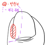 [드루와] 니네 내성발톱 수술 해봣냐...