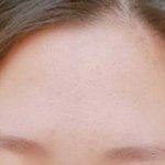 [드루와] 나 좁쌀여드름 박멸했다!!!(사진있)