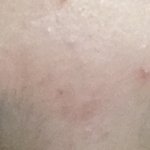 [드루와] <b>좁쌀</b>여드름 각질제거해야되나ㅠㅠㅜㅠ