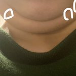 [댓글부탁해] <b>턱살</b>에 몽우리가 잡히는데 이거뭐야?
