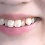 [조언부탁해] <b>덧니</b> 교정해야될까