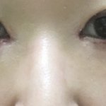 [이것좀봐줘] 앞트임 후기