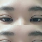 쌍수 오늘했는데