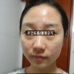 화농성 여드름 <b>박멸</b>한 후기(전후사진 있음)