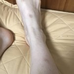 [댓글부탁해] 애들아 다리 <b>흉터</b> 없애는법좀 ㅠ