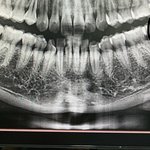 매복 사랑니 <b>발치</b> 후기 ^^...