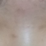 [댓글부탁해] 쌍수재수술 같은 원장님 vs 다른 원장님