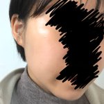 [드루와] 피부 개 <b>조아</b>짐 여드름 없앤 방법 공유할<b>게</b>