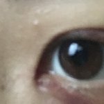 쌍수 <b>실밥</b> 빼고 왔당