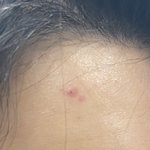 여드름 <b>딱지</b> 뭘로 해결해야 하나요?(사진주의(