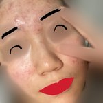 약혐.. <b>좁쌀</b> 여드름 들어가는중