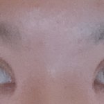 [댓글부탁해] <b>쌍수</b> 붓기 (사진 주의:)