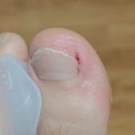 혐주의)내성발톱 때문에 <b>잠</b>이 안<b>옴</b>