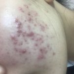 <b>여드름약</b> 복용 1일차