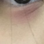 [댓글부탁해] 눈<b>밑살</b>이 빨갛고 따가운데 피부과vs안과