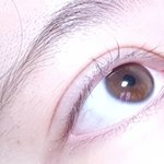 <b>쌍수티</b> 심하냐?