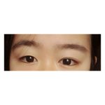 나라면 쌍수 한다 vs 안한다