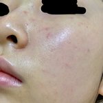 [댓글부탁해] ㅅㅂ 피부 _됐어 제발 도와줘..