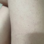 [19] 허벅지 <b>안쪽</b> 왜이래.. !!혐주의!!
