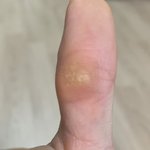 [댓글부탁해] 약혐) 이거 티눈인가?? 아님 <b>사마귀</b>?