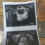난소암<b>수치</b>고위험군이나왔어요 도와주세요
