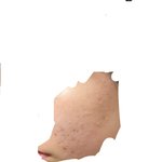 눈갱주의)<b>좁쌀</b>여드름 볼에 ㅈㄴ 많은데 어케해?