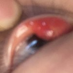 [혐주의] 제발 다래끼 째본사람 제발 제발 제발 들어와줘 ㅠㅠㅠ