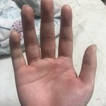 악 ㅅㅂ 얘들아 손바닥 너무 아픈데 어떡해..?
