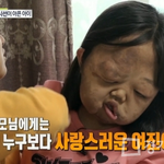 신경섬유종증 14살 소녀의 안타까운 삶