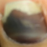 [꼭조언부탁] 내 발톱 좀 <b>바바</b>...