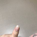 [망함ㅋ] 내 <b>엄지손톱</b> 꺄악!!!!!!!!!!!!!