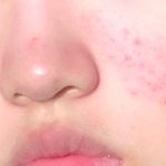 [댓글부탁해] 애들아 내 여드름 <b>화농성</b>이야??