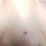 [댓글부탁해] 코 <b>피지</b> 짰는데 구멍 개크게 남(혐주의)