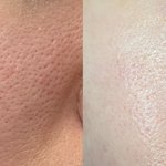 사진)나 홈<b>케어</b>로 모공 많이 좋아졌어!