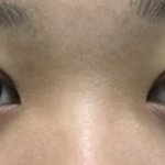 나 오늘 쌍수했는데 어땨ㅐ??
