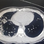 폐렴에 숨진 17세 고교생 <b>CT</b>·엑스레이 공개…의료계 해석 분분